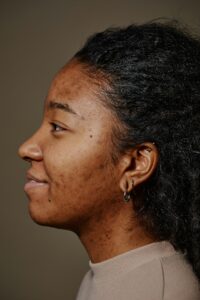 Close up profile smiling black woman with acne scars on face