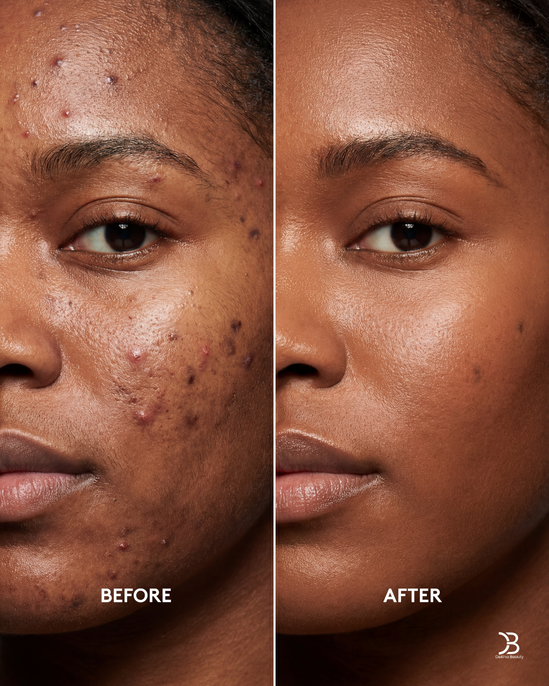 Dark Spots & Hyperpigmentation