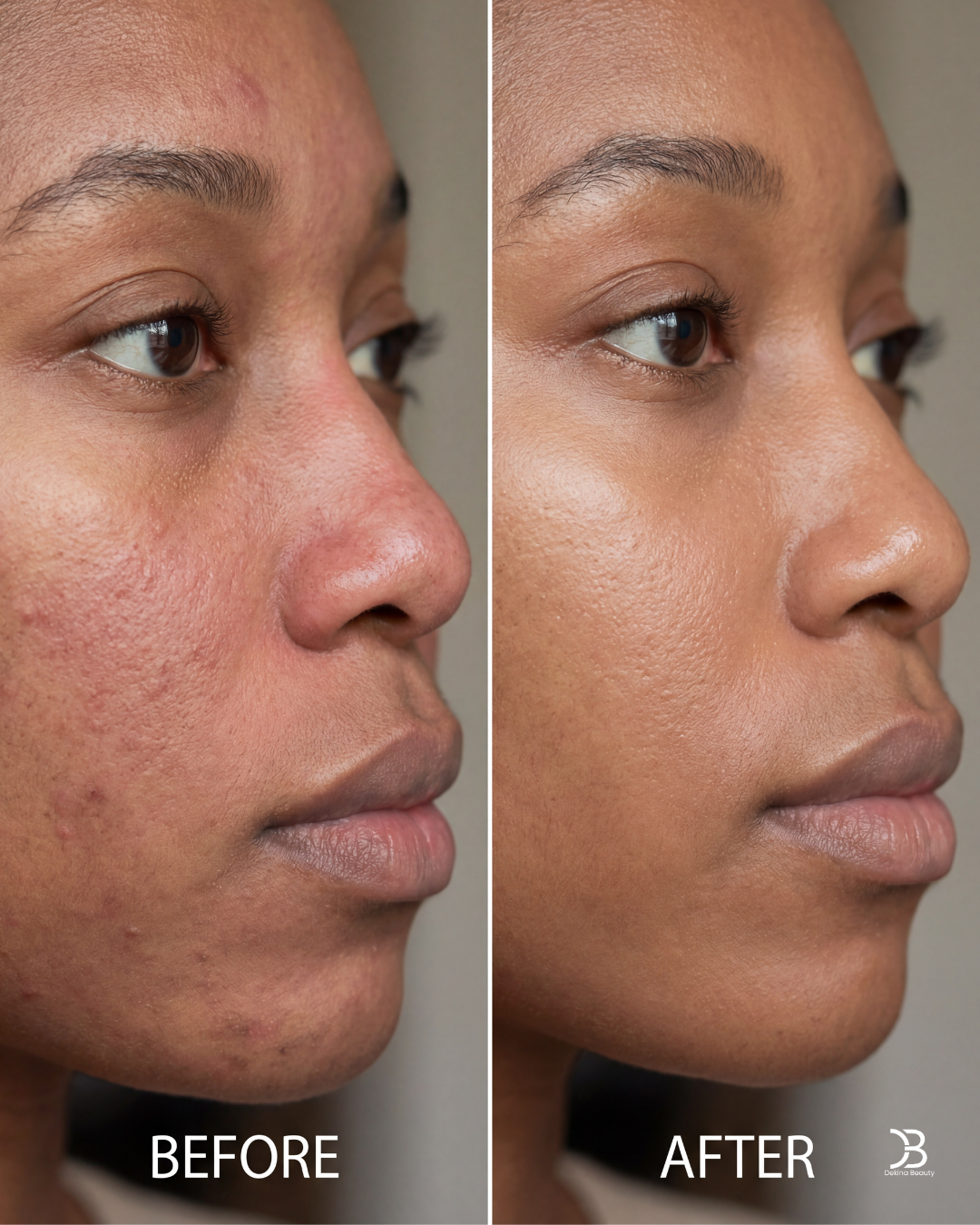 Dullness & Uneven Tone